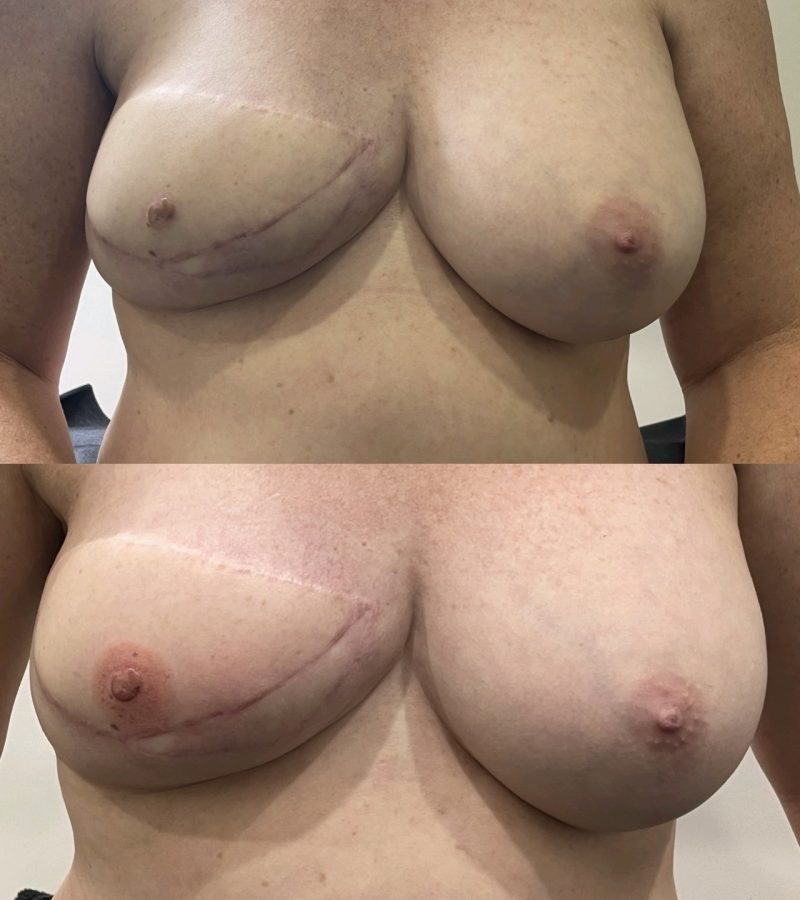 Unilateral (single) areola tattoo