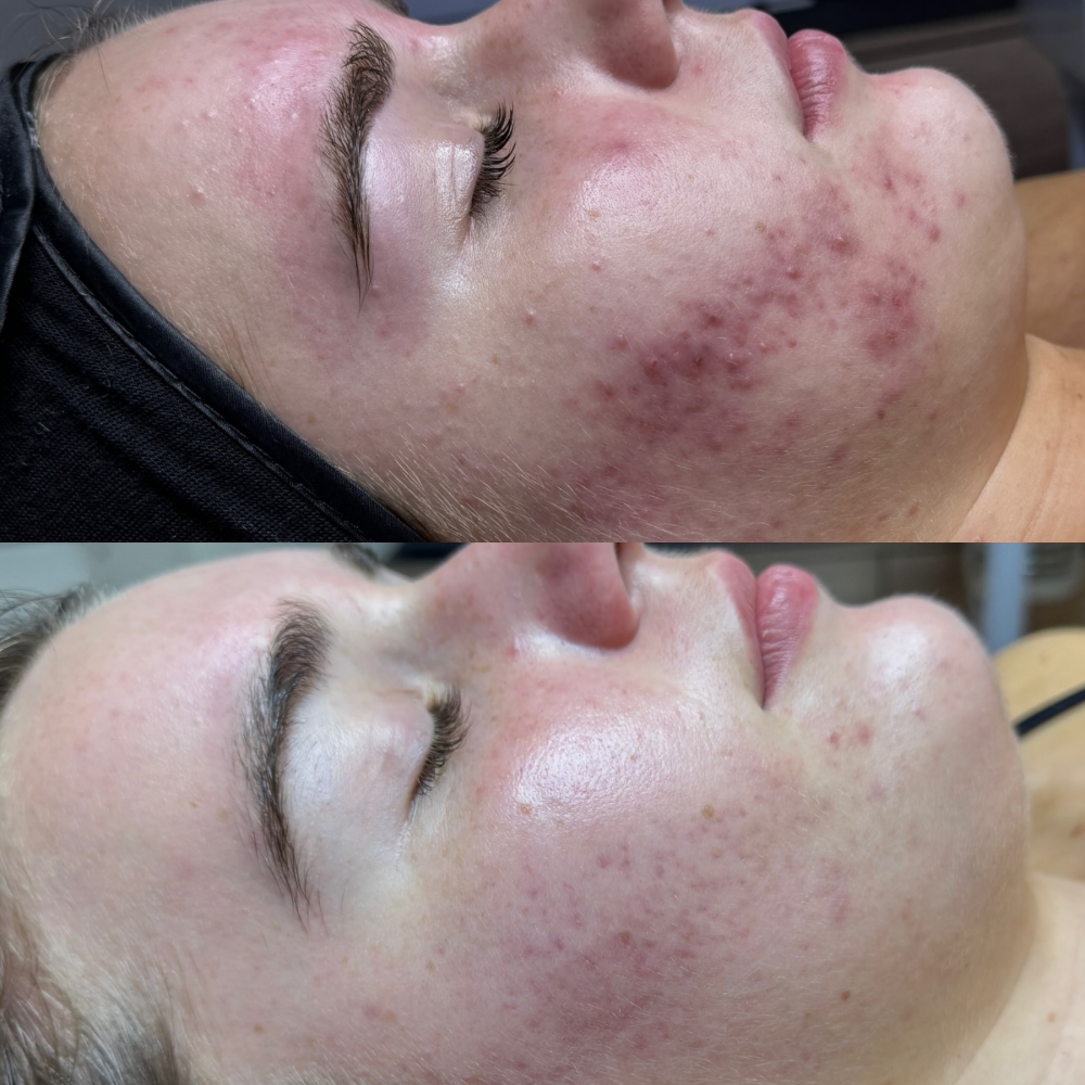 Acne Program