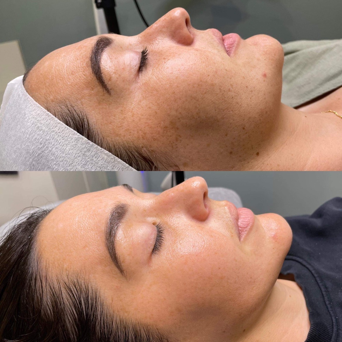 2nd treatment -2
