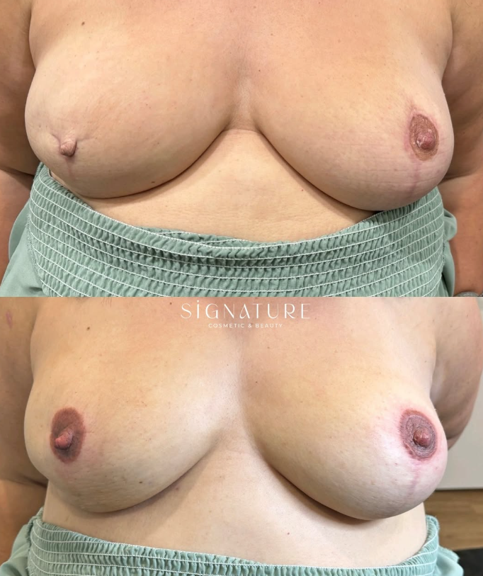 unilateral 1